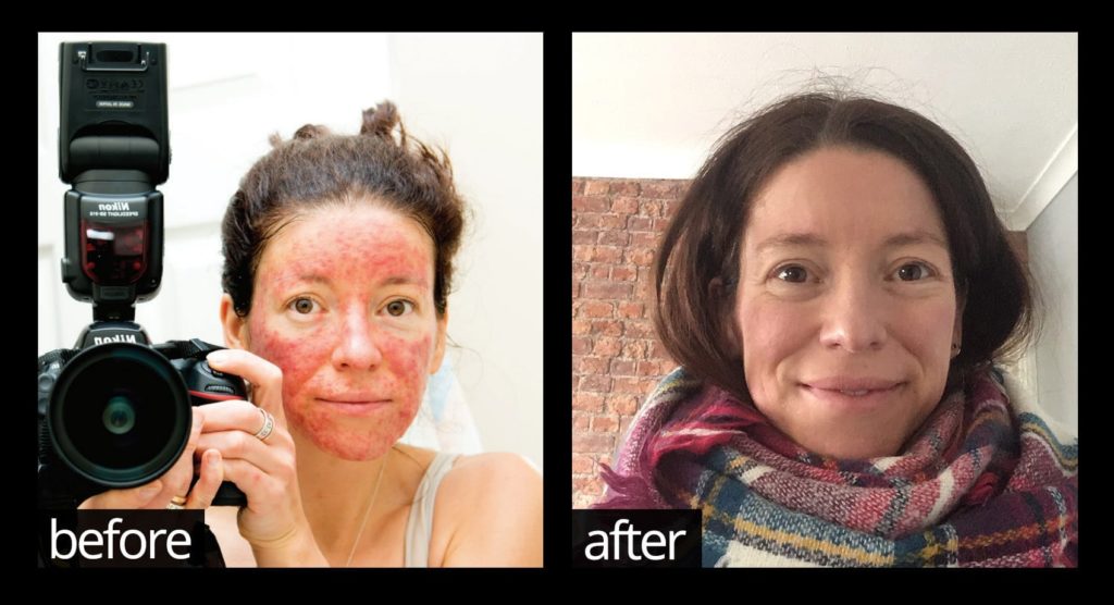 The real reason that nothing has ever worked to resolve your acne, eczema, psoriasis or rosacea – until now!